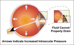 Glaucoma Pittsfield MA