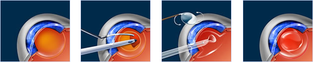 Cataract Surgery Pittsfield MA